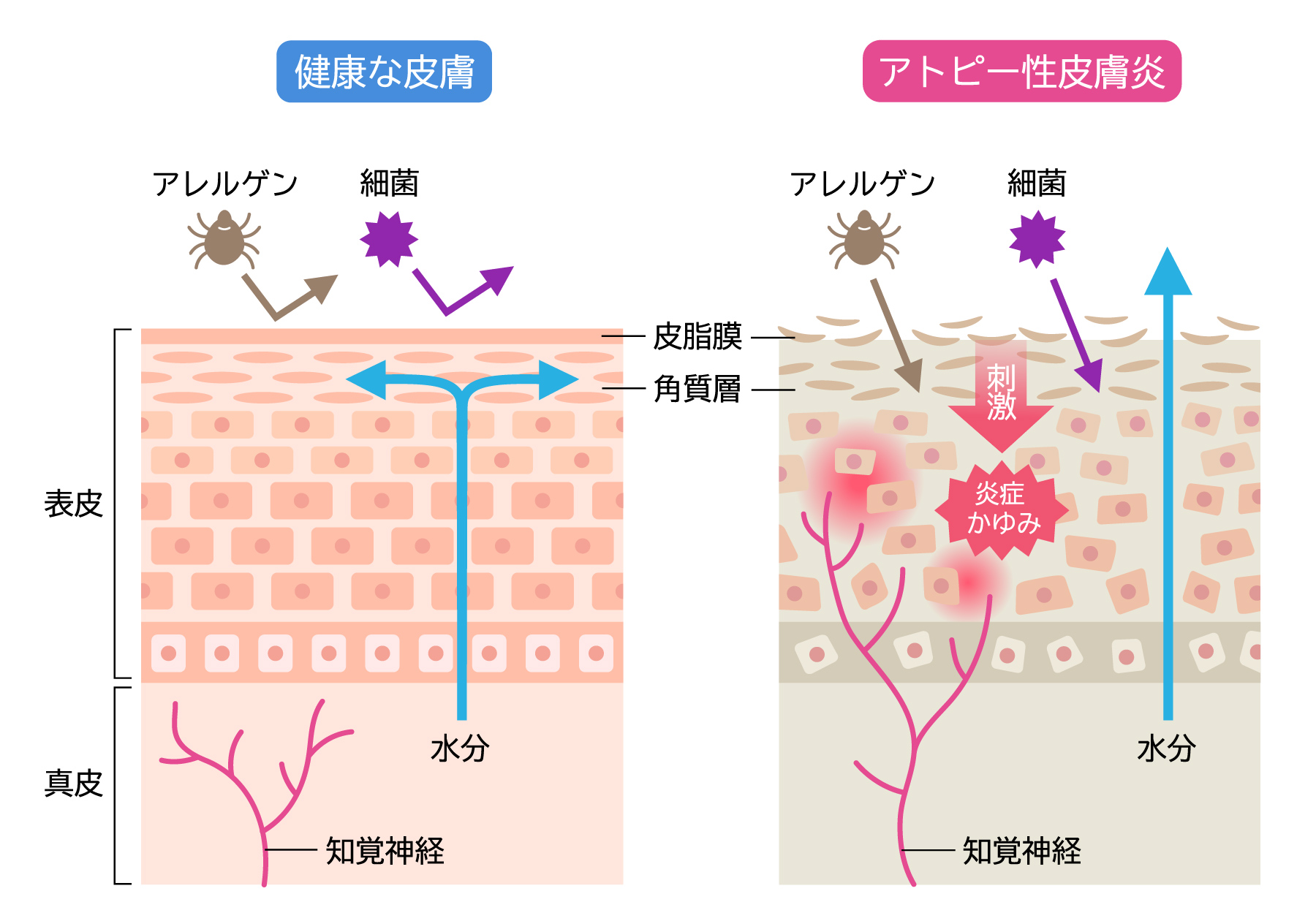 健康な皮膚とアトピー性皮膚炎の違い